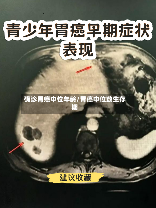 确诊胃癌中位年龄/胃癌中位数生存期