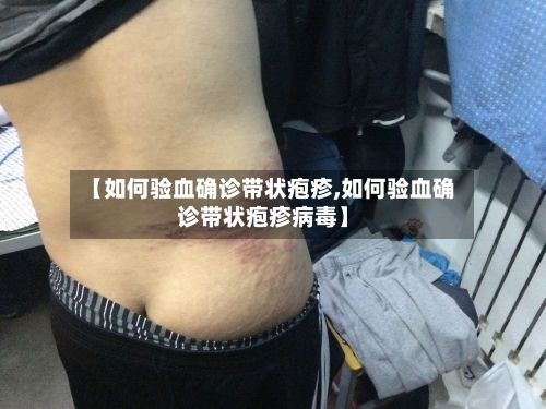 【如何验血确诊带状疱疹,如何验血确诊带状疱疹病毒】