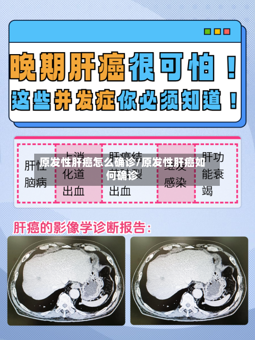 原发性肝癌怎么确诊/原发性肝癌如何确诊