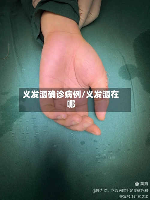 义发源确诊病例/义发源在哪
