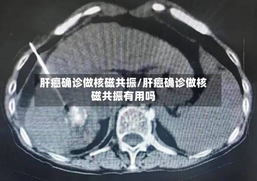 肝癌确诊做核磁共振/肝癌确诊做核磁共振有用吗