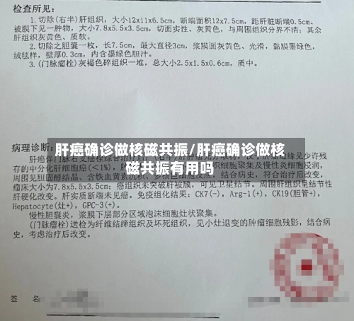 肝癌确诊做核磁共振/肝癌确诊做核磁共振有用吗