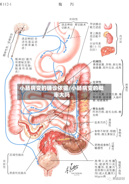 小肠病变的确诊依据/小肠病变的概率大吗