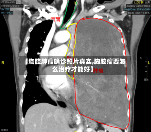 【胸腔肿瘤确诊照片真实,胸腔瘤要怎么治疗才能好】