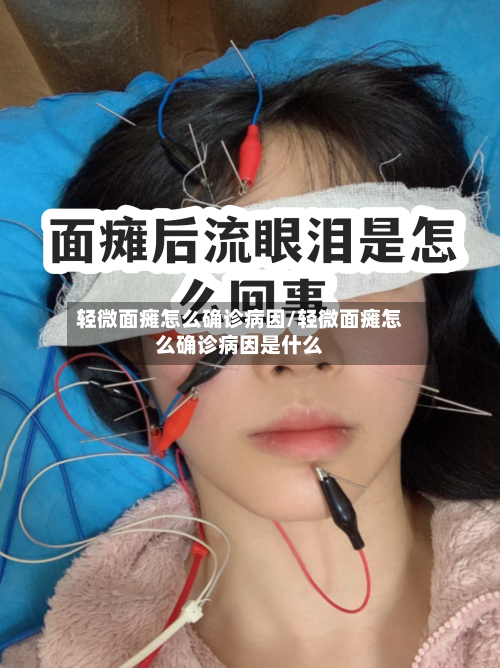 轻微面瘫怎么确诊病因/轻微面瘫怎么确诊病因是什么