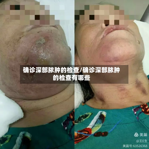 确诊深部脓肿的检查/确诊深部脓肿的检查有哪些