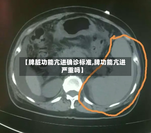 【脾脏功能亢进确诊标准,脾功能亢进严重吗】