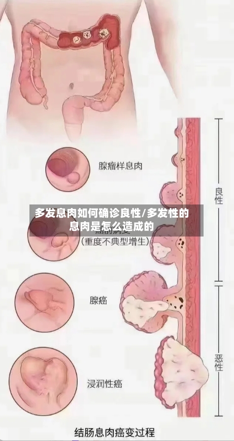 多发息肉如何确诊良性/多发性的息肉是怎么造成的