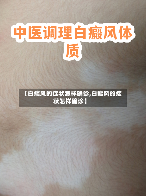 【白癜风的症状怎样确诊,白癜风的症状怎样确诊】