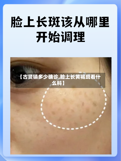 【古贤镇多少确诊,脸上长黄褐斑看什么科】