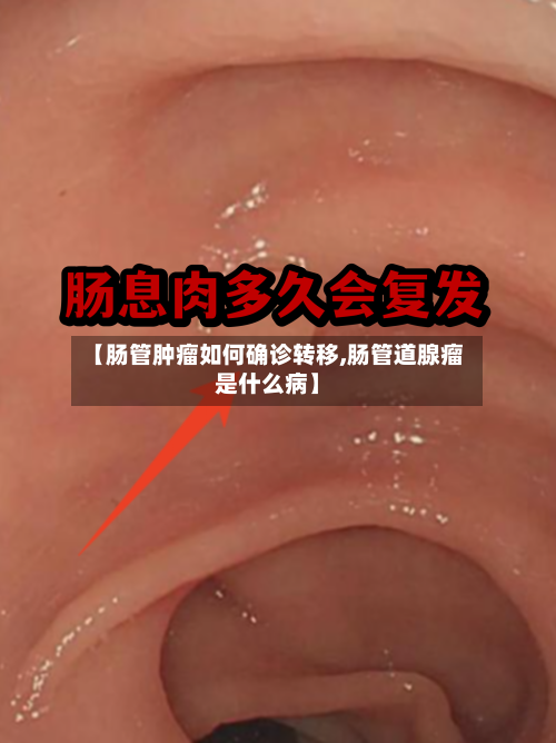 【肠管肿瘤如何确诊转移,肠管道腺瘤是什么病】
