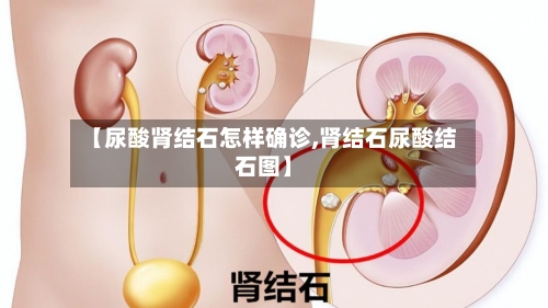 【尿酸肾结石怎样确诊,肾结石尿酸结石图】