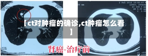 【ct对肿瘤的确诊,ct肿瘤怎么看】