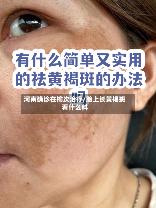 河南确诊在榆次治疗/脸上长黄褐斑看什么科