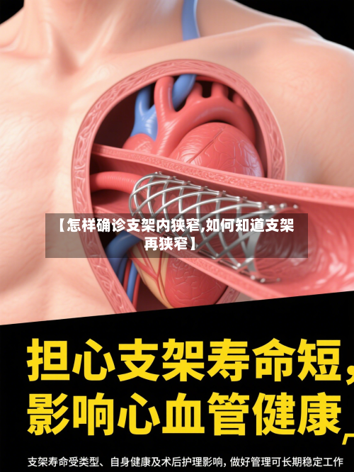 【怎样确诊支架内狭窄,如何知道支架再狭窄】